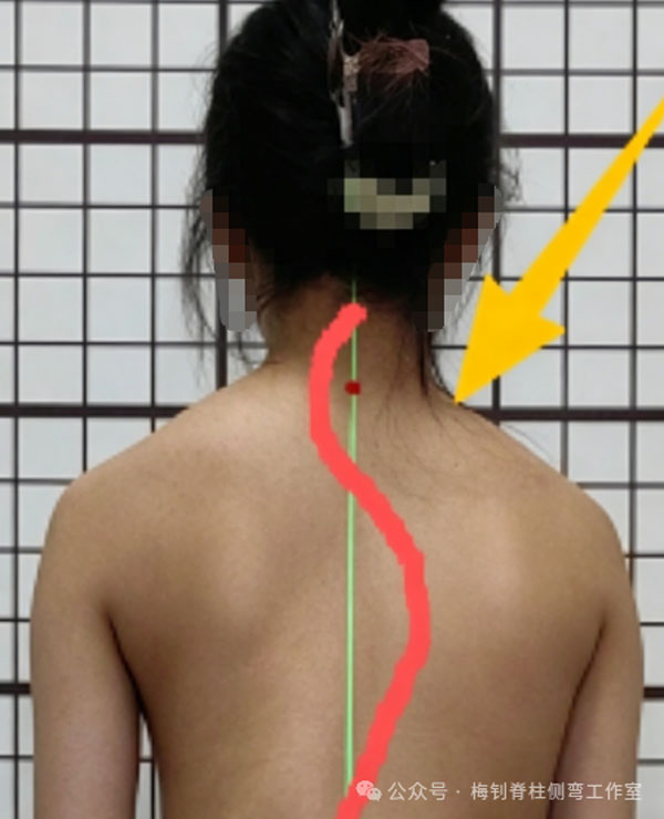 脊柱侧弯知识