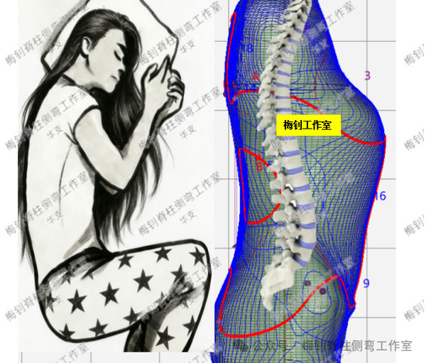 脊柱侧弯保守治疗培训班
