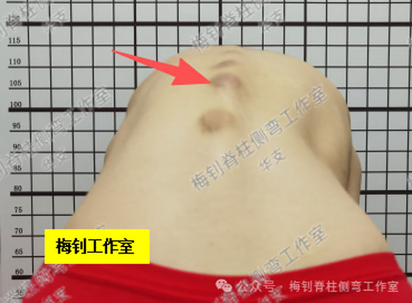 脊柱侧弯保守治疗培训班