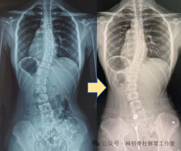 支具穿戴前后X光片对比