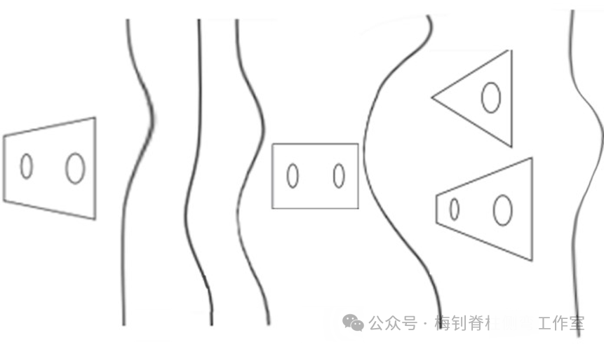 不同类型脊柱侧弯示意图