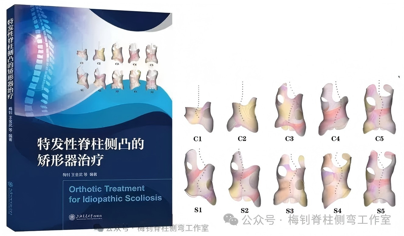 脊柱侧弯使用支具能调整到多少度