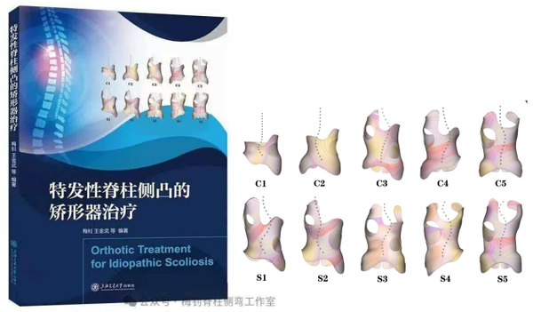 特发性脊柱侧凸的矫形器治疗与华支分型