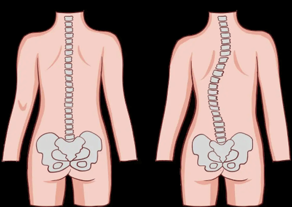 脊柱侧弯知识