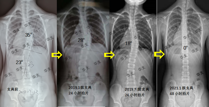 脊柱侧弯