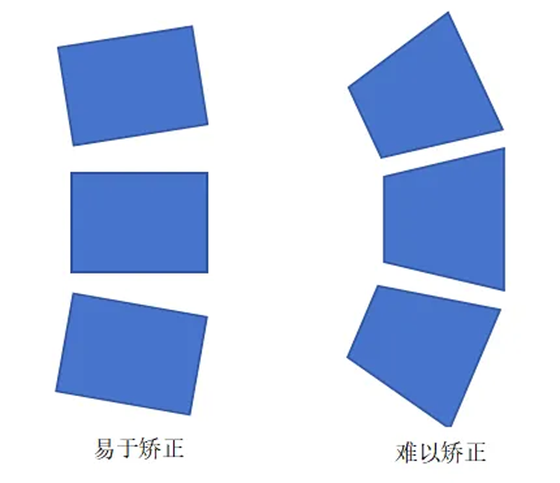 脊柱侧弯