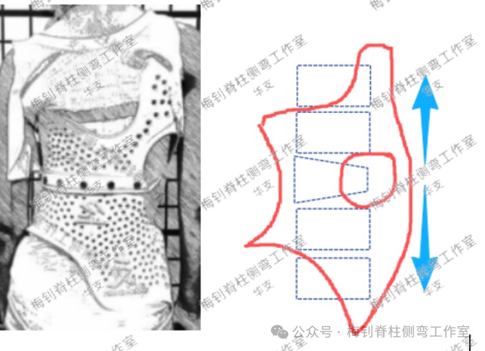脊柱侧弯保守治疗培训班