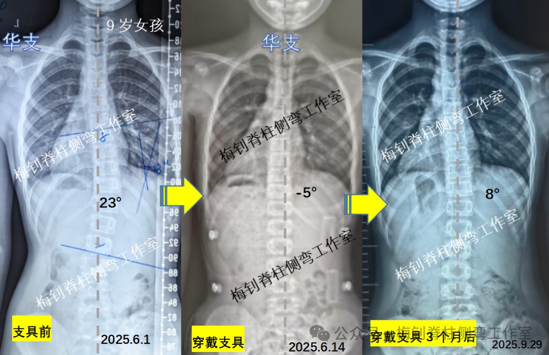 脊柱侧弯保守治疗培训班
