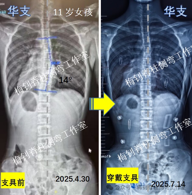 脊柱侧弯保守治疗培训班