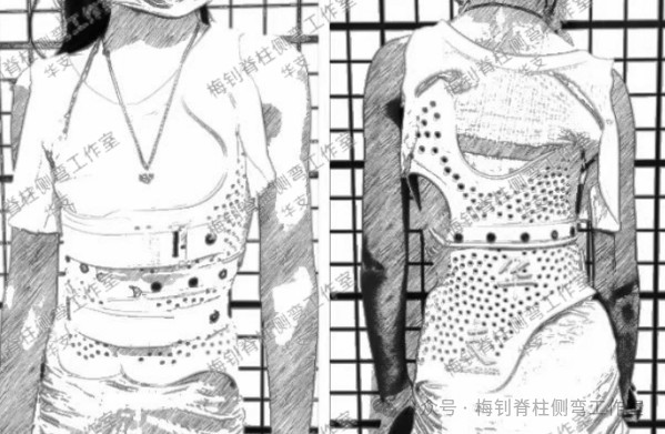 脊柱侧弯保守治疗培训班