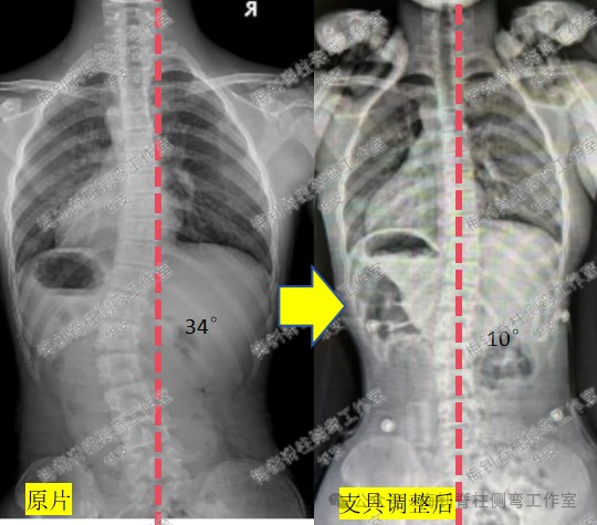 脊柱侧弯保守治疗培训班